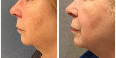 Chemical Peel before and after photo
