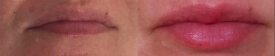 Dermal Fillers before and after photo