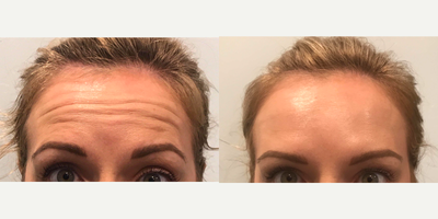 Dysport before and after photo