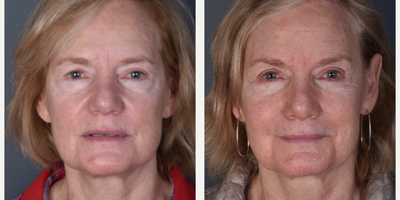 Mini Facelift before and after photo