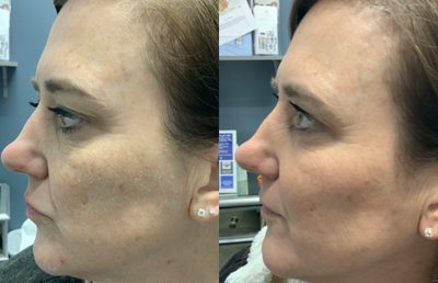 Voluma before and after photo