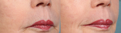 CO2 Laser before and after photo