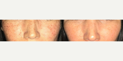 IPL before and after photo