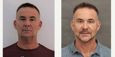 Lower Facelift before and after photo