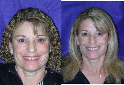 Porcelain Veneers before and after photo