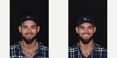 Porcelain Veneers before and after photo