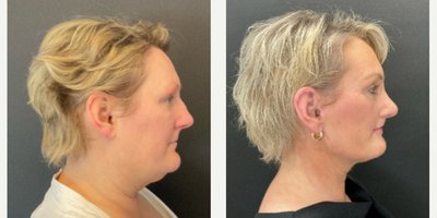 Facelift before and after photo