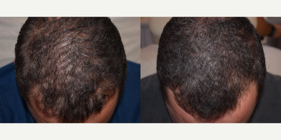 Hair Loss Treatment before and after photo