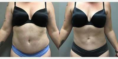 Liposuction before and after photo