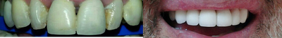 Smile Makeover before and after photo