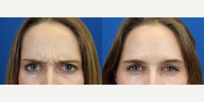 Botox before and after photo