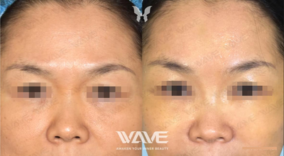 Brow Lift before and after photo