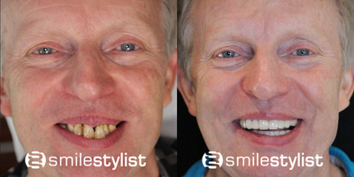 Dental Implants before and after photo