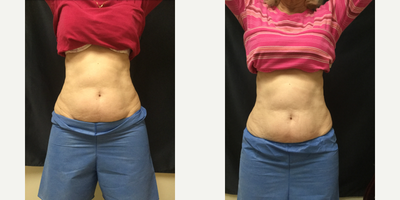 SculpSure before and after photo