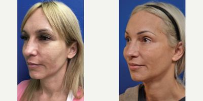 Sculptra before and after photo