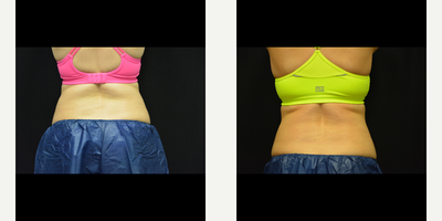 CoolSculpting before and after photo