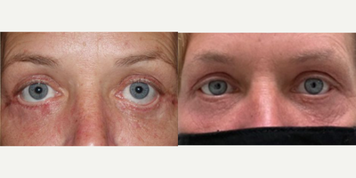 Eyelid Retraction Repair before and after photo