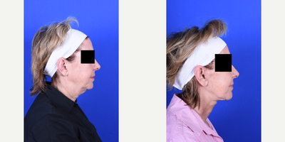 Neck Lift before and after photo