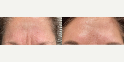 Botox before and after photo