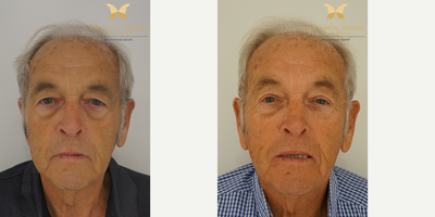 Eyelid Surgery before and after photo