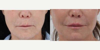 Facial Fat Transfer before and after photo