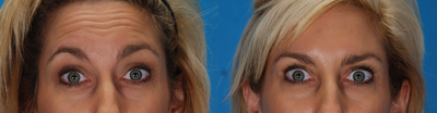 Botox before and after photo