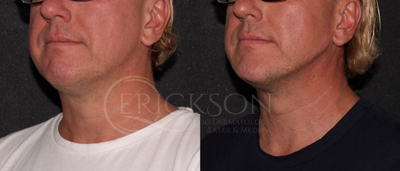 CoolSculpting before and after photo