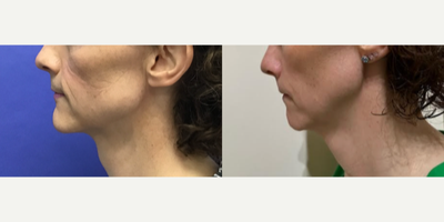 Genioplasty before and after photo