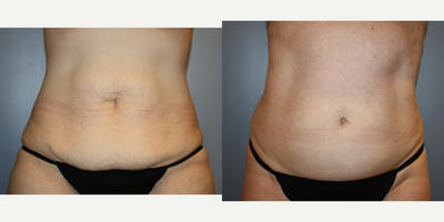 Liposuction before and after photo