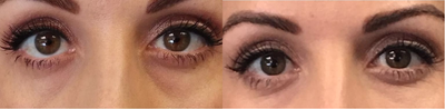 Belotero before and after photo