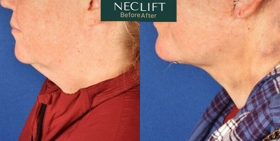 Deep Plane Facelift before and after photo