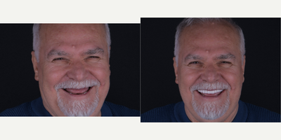 Dental Implants before and after photo