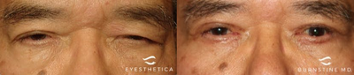 Double Eyelid Surgery before and after photo