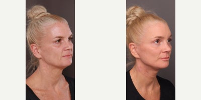 Facelift before and after photo