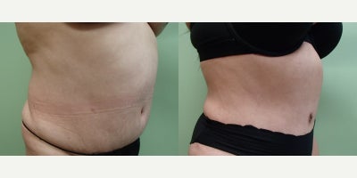 Liposuction before and after photo