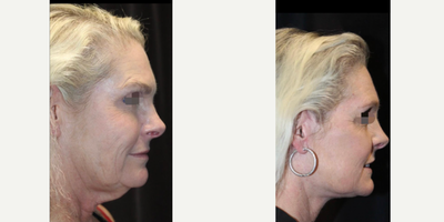 Neck Lift before and after photo