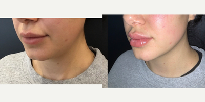 Restylane before and after photo