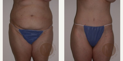 Tummy Tuck before and after photo