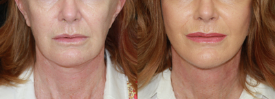 Facial Fat Transfer before and after photo