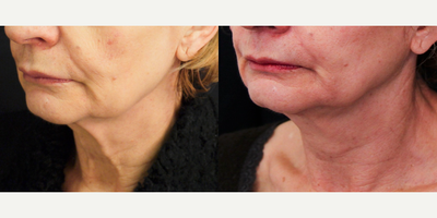 Infini RF before and after photo