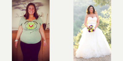 Lap Band before and after photo