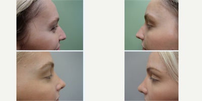 Rhinoplasty before and after photo