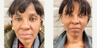 Thread Lift before and after photo