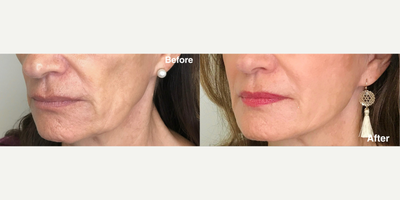 Cheek Fillers before and after photo