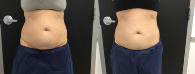 CoolSculpting before and after photo