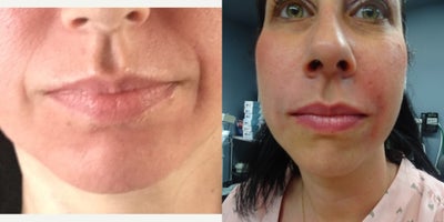 Restylane before and after photo