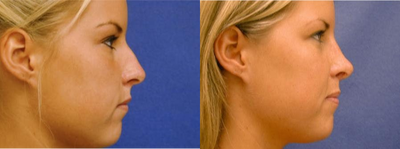 Rhinoplasty before and after photo