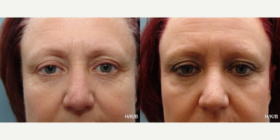 CO2 Laser before and after photo