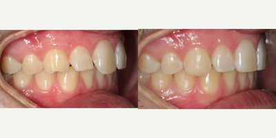 Dental Bonding before and after photo