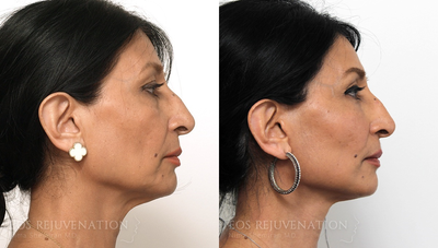 Facelift before and after photo